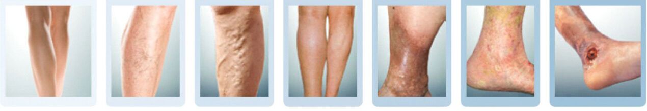 stage of development of varicose veins in the legs