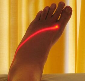 laser treatment of varicose veins in the legs
