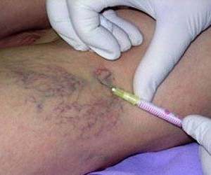 cock-of-the varicose veins