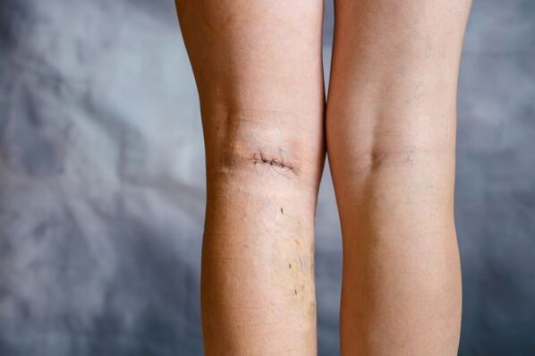 sutures on the leg after surgery for varicose veins
