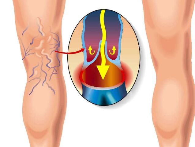 legs and healthy varicose veins in the legs