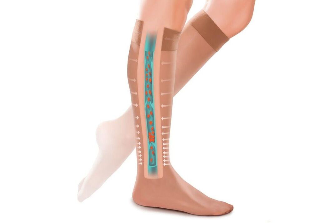effect of compression stockings on legs with varicose veins