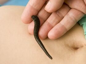 leeches for the treatment of varicose veins