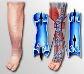 blood flow in the legs with varicose veins