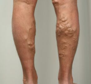 varicose veins on the legs with varicose veins