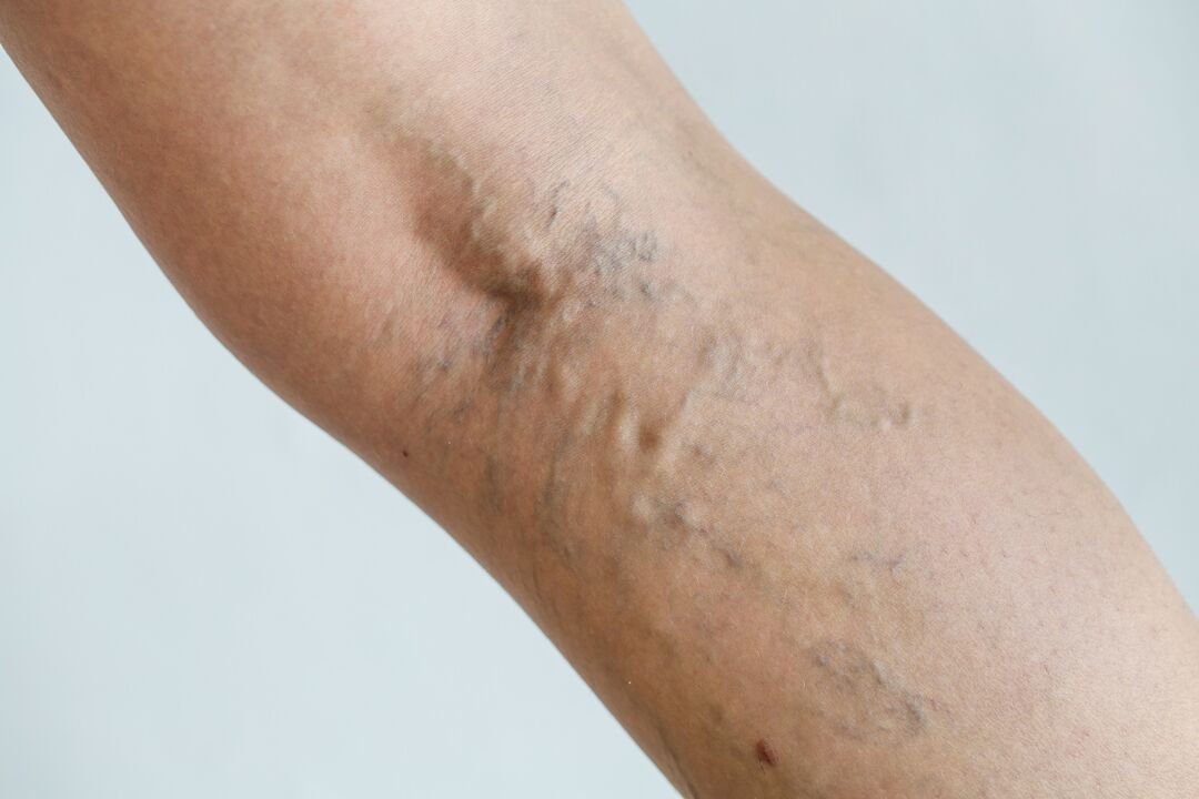 varicose veins on the legs photo 1