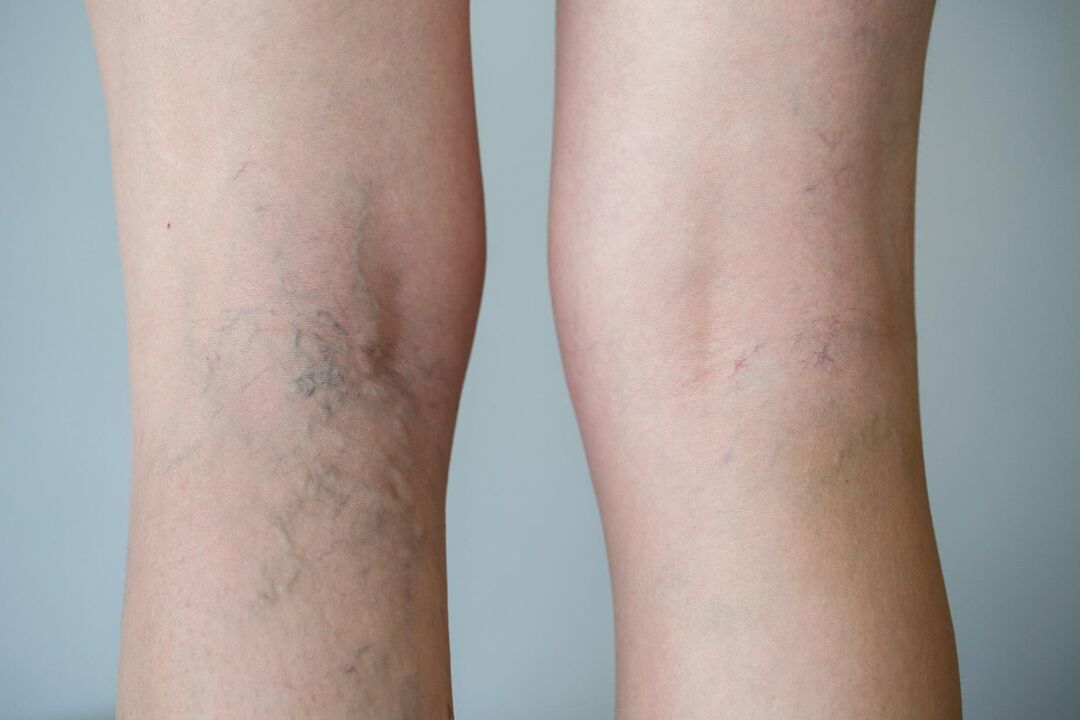 varicose veins on the legs photo 2