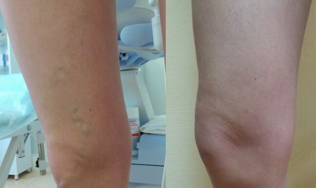 legs before and after reticular varicose vein treatment