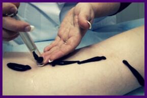 Procedures for treating varicose veins with leeches (hirudotherapy)
