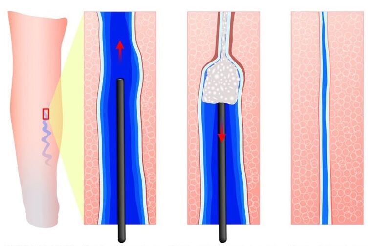 sclerotherapy for labial varicose veins