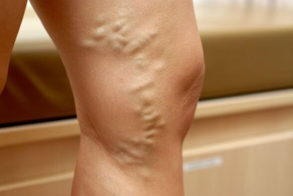 varicose veins on the legs with small pelvic varicose veins