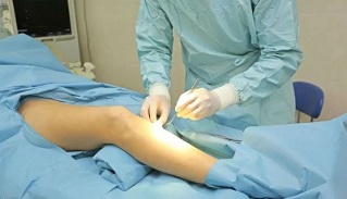 how surgery for varicose veins is performed