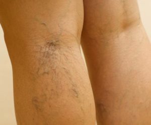 the pain during the treatment of varicose veins