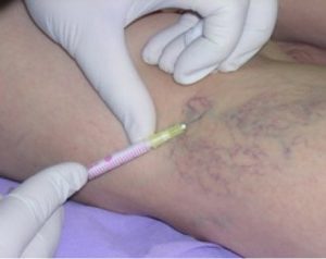 the pain of varicose veins fluids treatment