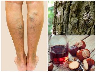 the treatment of varicose veins in the legs folk media
