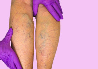 the causes of varicose veins