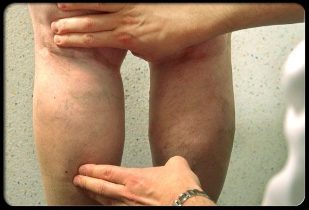 The doctor examined the leg with varicose veins