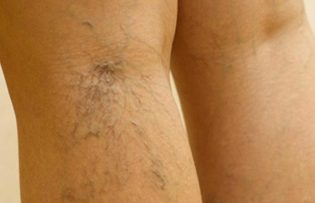 the treatment of varicose veins feet