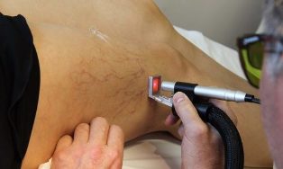 the laser treatment of the varicose veins