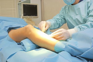The varicose veins surgery