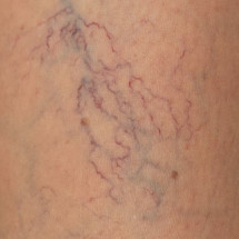 The manifestations of the varicose veins