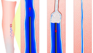 Introduction of sclerosant when sclerotherapy