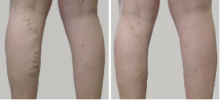 Pre-and post-treatment
