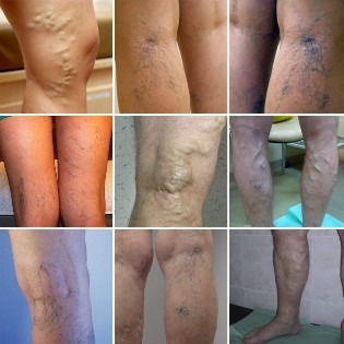 Photo varicose veins of the veins of the lower limbs